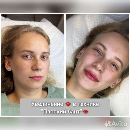 Увеличение губ