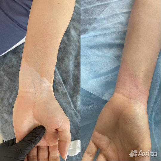 Камуфляж шрама/ ареолы/витилиго/татуаж тату