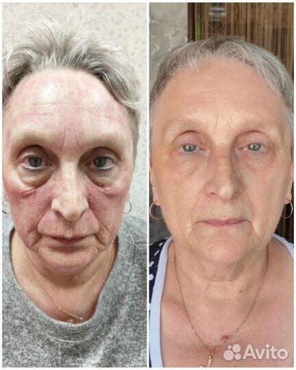 SMAS лифтинг, лифтинг лица и тела