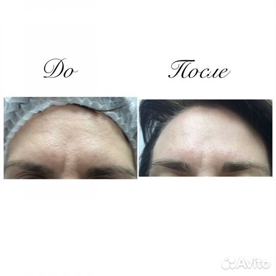 Комбинированная чистка лица