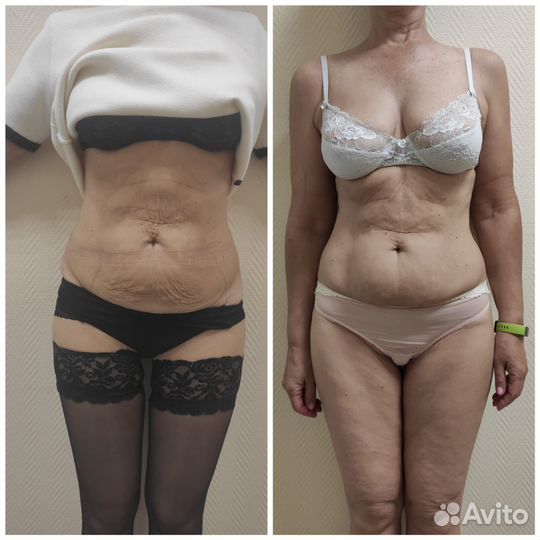 Криолиполиз