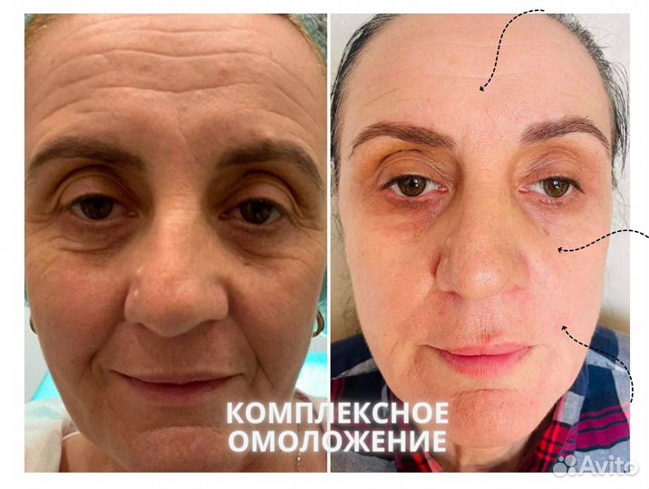 Комплексная программа омоложения лица