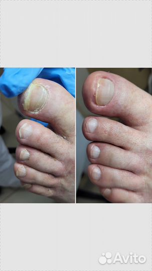 Педикюр подолог