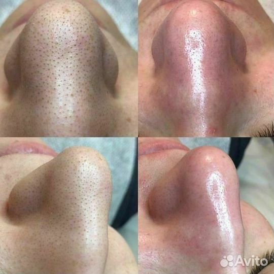 Чистка лица + пилинг в подарок