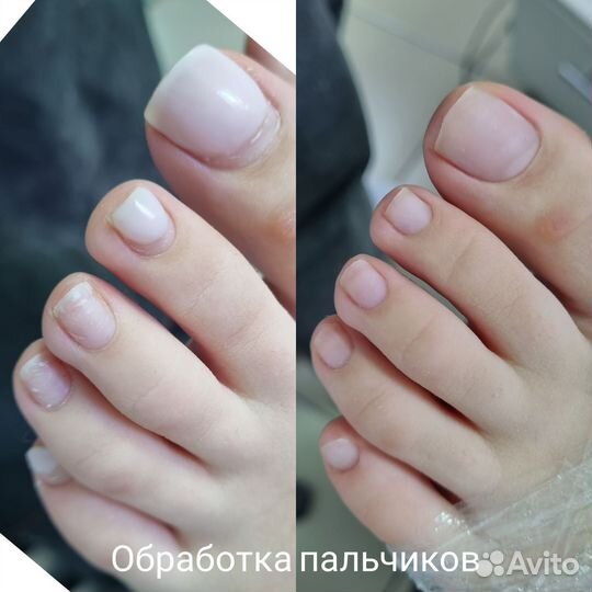 Подология педикюр