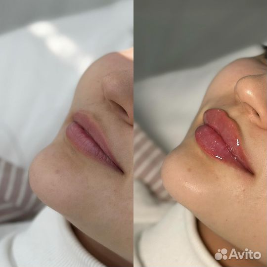 Модель на увеличение губ