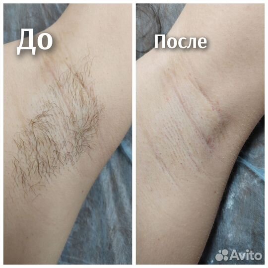 Восковая эпиляция