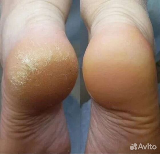 Медицинский педикюр (подолог)