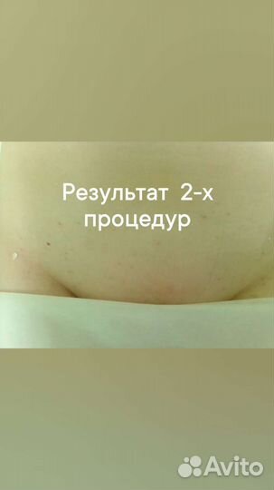 Лазерная эпиляция, удаление тату, татуажа