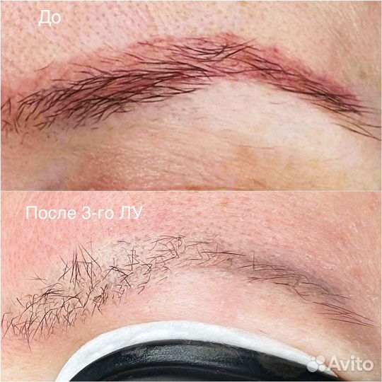 Удаление тату и татуажа лазером и ремувером