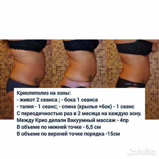 Криолиполиз Массаж Кавитация (коррекция фигуры)