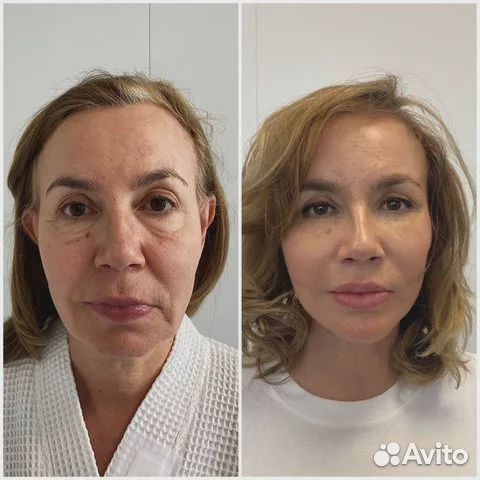 Подтяжка лица за 1 процедуру Эффект сразу