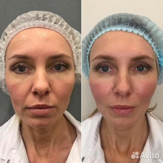 Модель на смас лифтинг\рф игольчатый/рф лифтинг