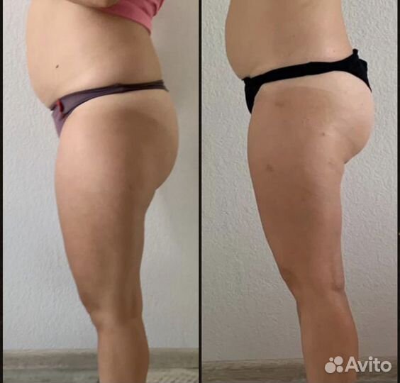 Массаж лица, Антицеллюлитный массаж