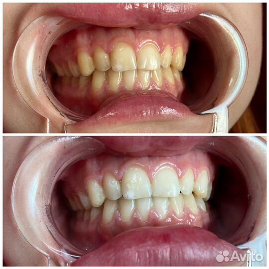 Косметическое отбеливание зубов