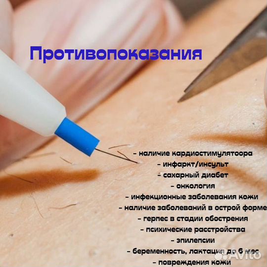 Электроэпиляция