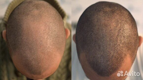 Камуфляж рубцов и шрамов,витилиго