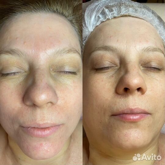 Омолаживающий массаж лица