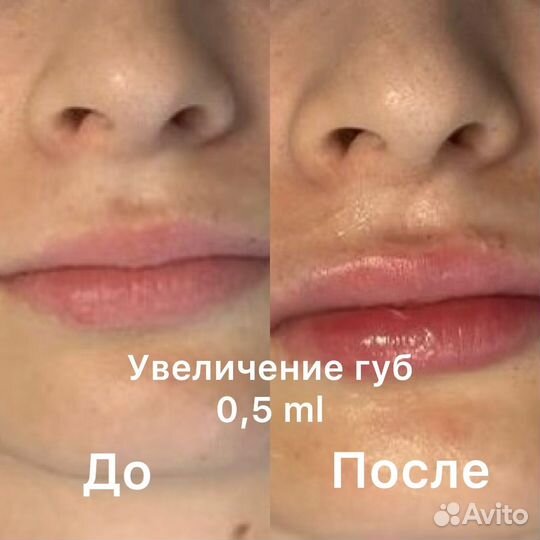Увеличение губ, Монако, Ботокс, мезо, био