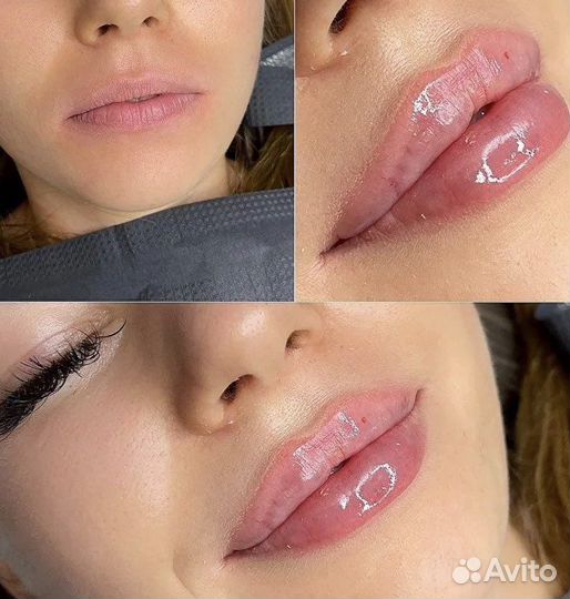 Увеличение губ