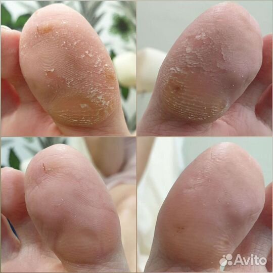 Педикюр медицинский, эстетический