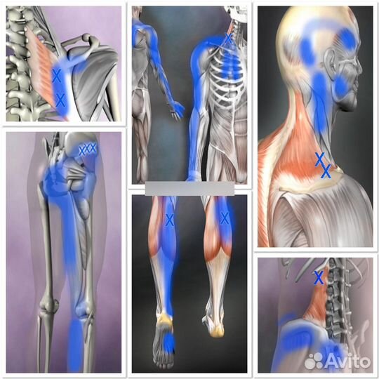 Миопрессура