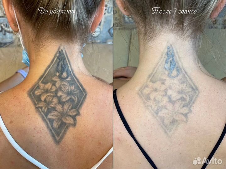 Удаление Татуажа и Тату без Шрамов и Ожогов