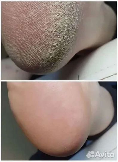 Медицинский педикюр (подолог)