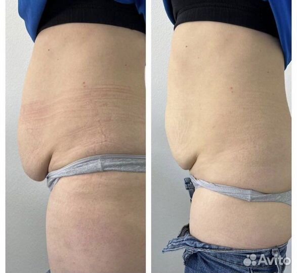 Вакуумный массаж Турбомассаж коррекция фигуры