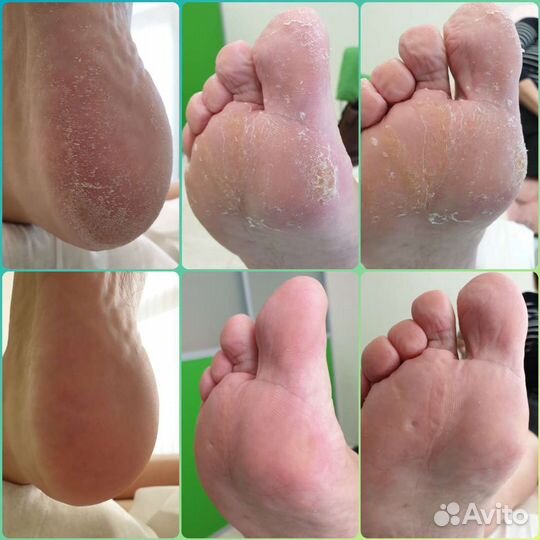 Педикюр медицинский, эстетический