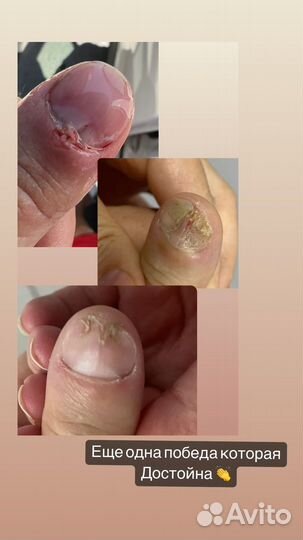 Подолог. Вросший ноготь. Титановая нить