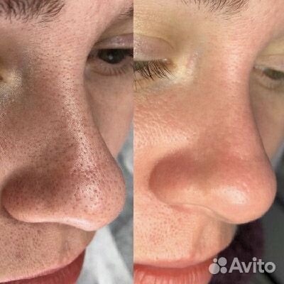 Чистка лица модель