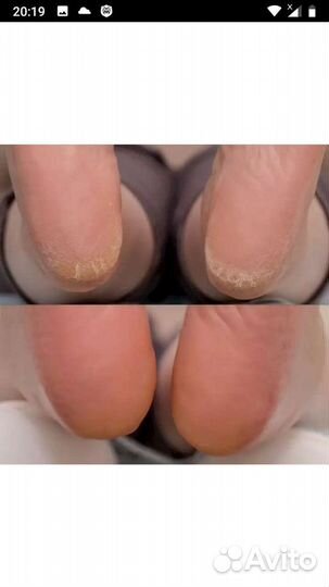 Медицинский педикюр