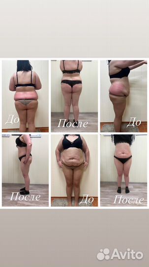 Мастер LPG массажа