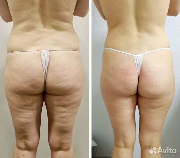 Антицеллюлитный массаж