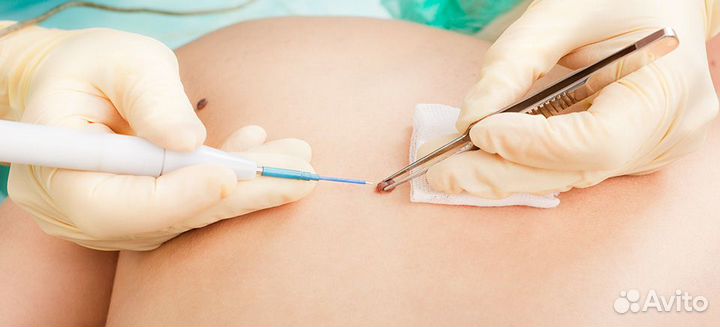 Удаление новообразований