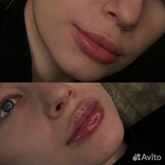 Увеличение губ