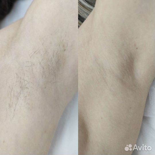 Депиляция Педикюр Подология Титановая нить