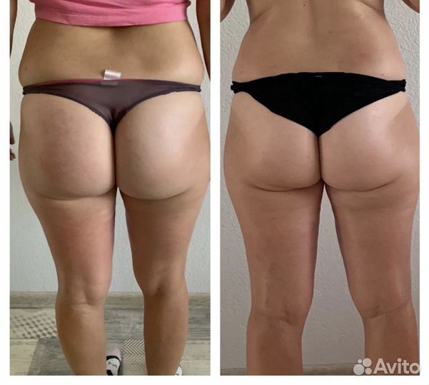 Массаж лица, Антицеллюлитный массаж