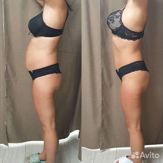 Криолиполиз, кавитация, ваккумный массаж