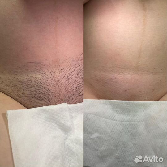 Депиляция