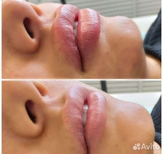 Увеличение губ, пластика губ