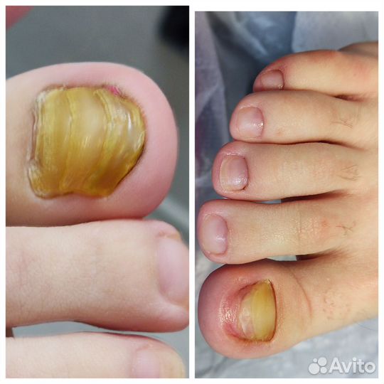 Педикюр для сложной стопы