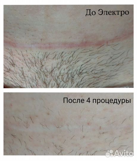 Электроэпиляция