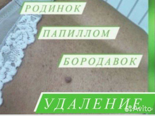 Удаление новообразований (папиллом)