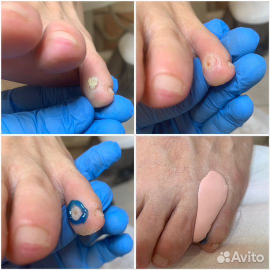 Педикюр,подолог,вросшие ногти