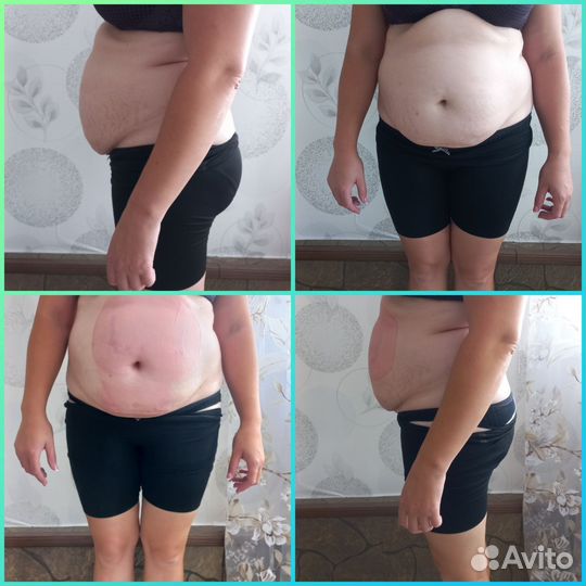 Криолиполиз минус 4-5 см за одну процедуру