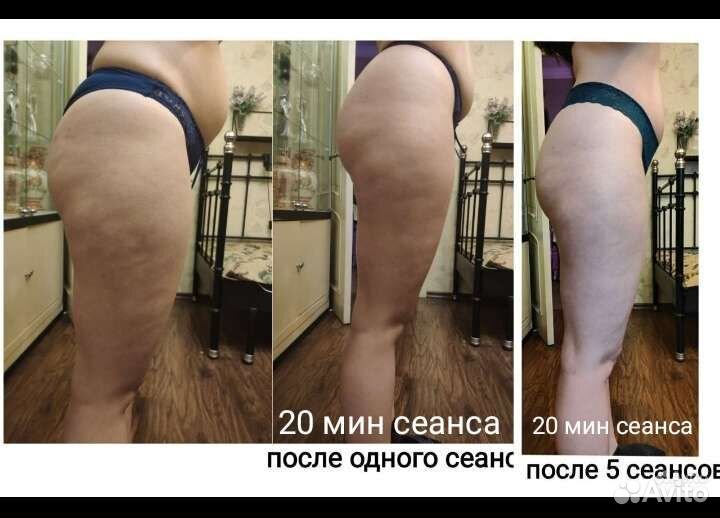 Антицеллюлитный массаж и коррекция фигуры