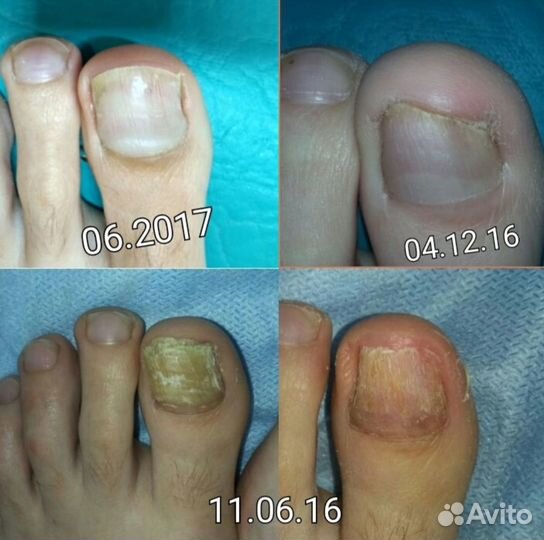 Медицинский педикюр подолог