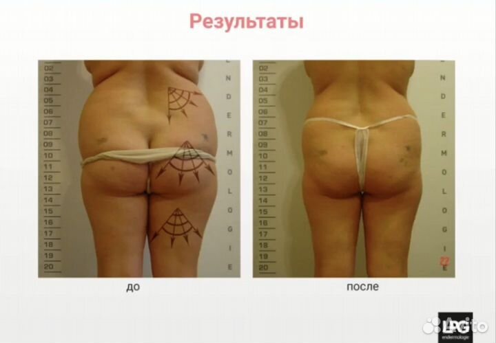 Lpg массаж лица и тела